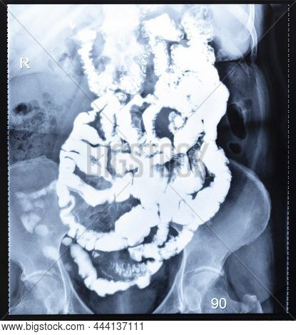 X-ray Radiogram With Barium Study Of Small Bowel After 90 (ninety) Minutes After The Start Of Passag