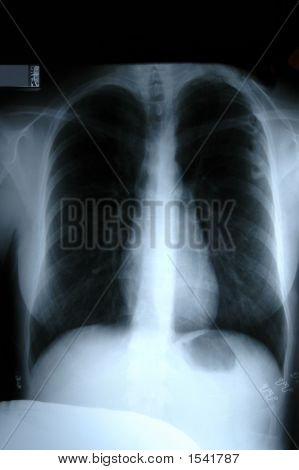 X-Ray trupu