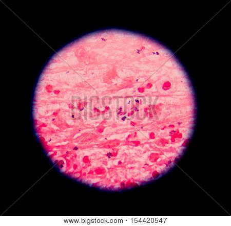 Gram Stain Showing Blue Cells Gram Positive In Single,in Pair,in Cluster Intracellular On Red White
