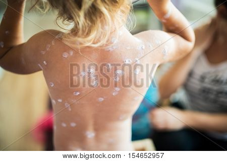 Back of little two year old girl at home sick with chickenpox. White antiseptic cream applied to the rash. Rear view.