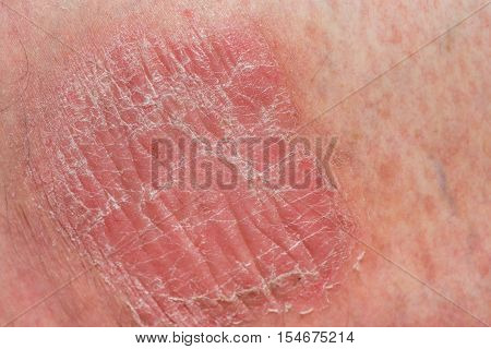 Psoriasis skin. Psoriasis is an autoimmune disease that affects the skin cause skin inflammation red and scaly.