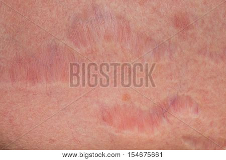 Psoriasis skin. Psoriasis is an autoimmune disease that affects the skin cause skin inflammation red and scaly.