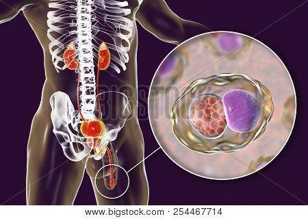 Chlamydiosis Infection In Man, 3d Illustration Showing Close-up View Of Chlamydia Trachomatis Bacter
