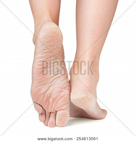 Sore Skin Of Feet, Crack, Dry Heels, Clipping Path