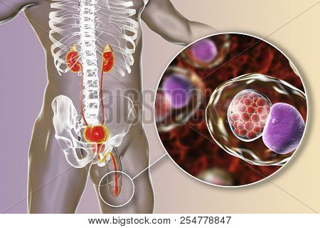 Chlamydiosis Infection In Man, 3d Illustration Showing Close-up View Of Chlamydia Trachomatis Bacter