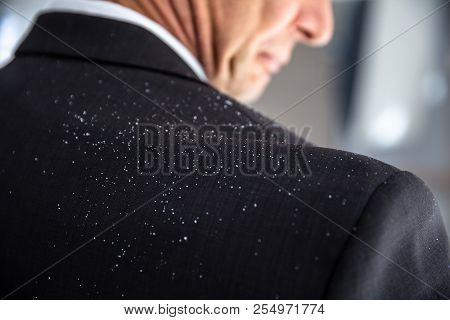 Close-up Of A Businessperson With Dandruff On His Shoulder