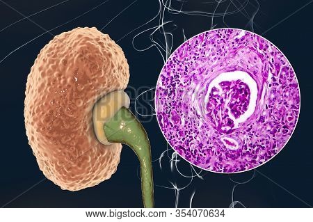 Chronic Glomerulonephritis, 3d Illustration Showing Pale Contracted Coarsely Granular Kidneys And Li