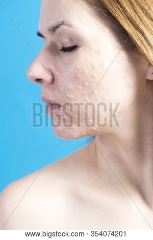 Biorevitalization Of Real Skin. Traces Of Biorevitalization Injections On A Woman's Face