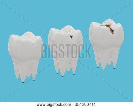 Three Stages Of Tooth Decay, Caries. 3d Illustration