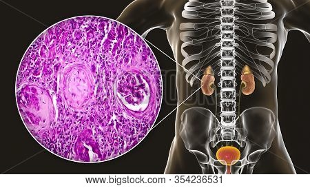 Chronic Glomerulonephritis, 3d Illustration Showing Pale Contracted Coarsely Granular Kidneys And Li