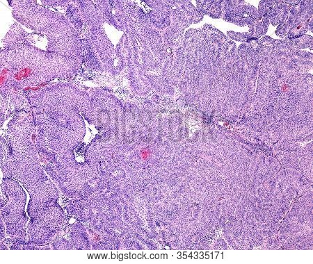 Microscopic Image Showing A Urinary Bladder Papilloma Formed By Papillae With Fibrovascular Core And