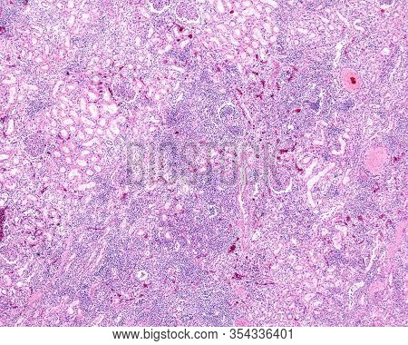 Low Magnification Micrograph Showing A Kidney Affected By A Chronic Pyelonephritis. Diffuse Infiltra