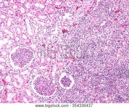 Renal Cortex Affected By A Chronic Pyelonephritis. The Renal Parenchyma In The Right Half Of The Ima
