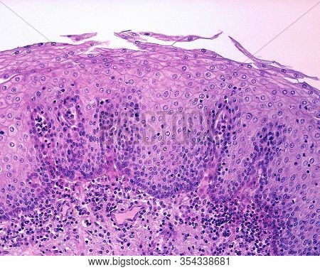 Epithelial Lining Of The Esophagus. It Is A Non-keratinized Stratified Squamous Epithelium, Whose Mo