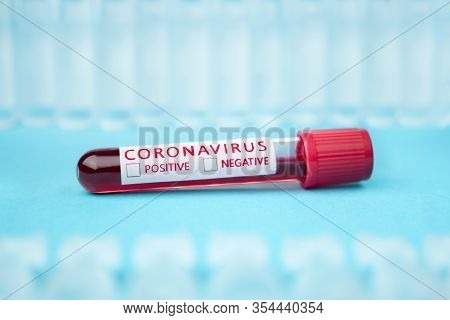 Coronavirus Covid-19 Infected Blood Sample In Sample Tube. Coronavirus Covid-19 Vaccine Research. Ho