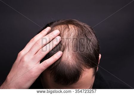Male Head Close-up With Baldness. Studio Black Background.