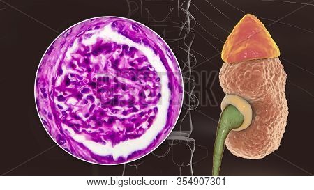 Chronic Glomerulonephritis, 3d Illustration Showing Pale Contracted Coarsely Granular Kidneys And Li