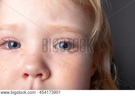 Conjunctivitis In The Eyes Of A Child, Pus And Inflammation Of The Eyes Of A Baby Girl Close-up