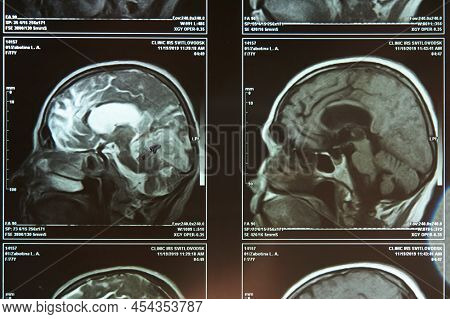 A Fragment Of An Image Of An Elderly Person's Brain Scan On Magnetic Resonance Imaging Mri Film For 