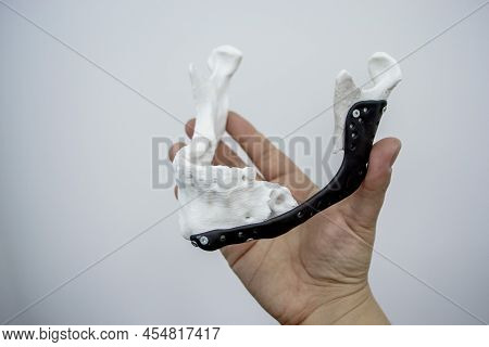 Man Holding Implantation Of Endoprosthesis Of Lower Jaw. Model Of Lower Jaw Printed On 3d Printer Wh