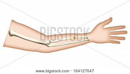 Fracture in the Wrist - Closeup with Bone