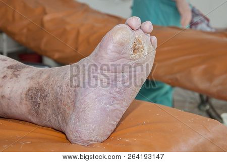 Diabetic Foot. Syndrome Of Diabetic Foot. Osteomyelitis Of The Foot.