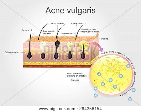 Acne Vulgarise Is A Long-term Skin Disease That Occurs When Hair Follicles Become Clogged With Dead 