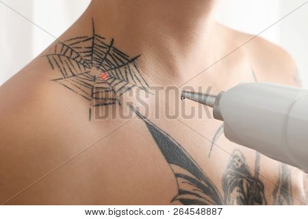 Man Undergoing Laser Tattoo Removal Procedure In Salon, Closeup
