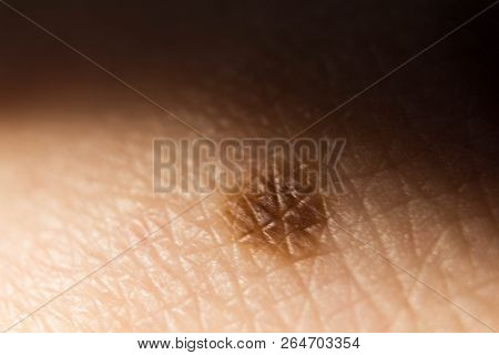Palm Close-up With A Birthmark. The Structure Of The Skin And Birthmark.