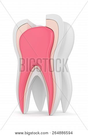 3D Render Of Tooth With Root Canal Treatment Procedure