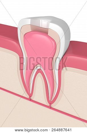3D Render Of Tooth With Root Canal Treatment Procedure
