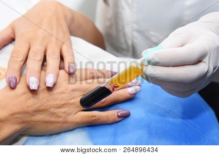 Plasmolifting hands. Injections for rejuvenation and skin regurgitation from human plasma. A modern 