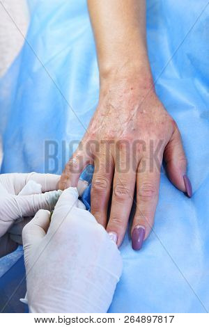 Plasmolifting Hands. Injections For Rejuvenation And Skin Regurgitation From Human Plasma. A Modern 