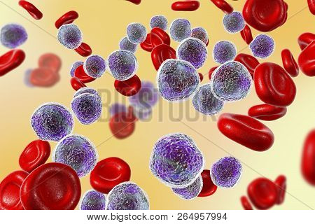 Acute Lymphoblastic Leukemia, Bone Marrow Smear, 3d Illustration