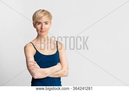 Female With Vitiligo Admit Her Body. Lifestyle Of Woman With Loss Of Melanin