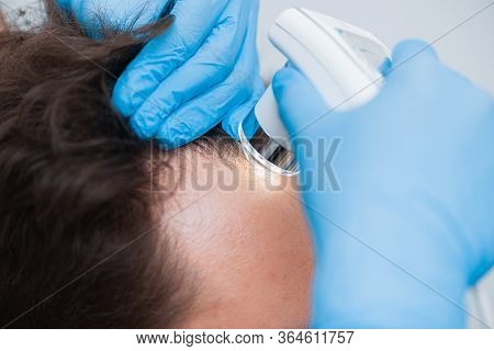 Trichoscopy Of Hair And Scalp Closeup. Trichoscope In The Hands Of A Doctor