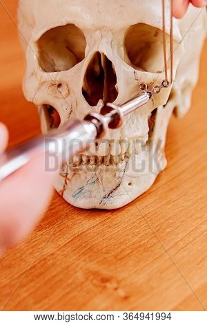 Maxillofacial Surgery With A Piece Of Overgrowth Bone Removed Holden In Forceps Close Up