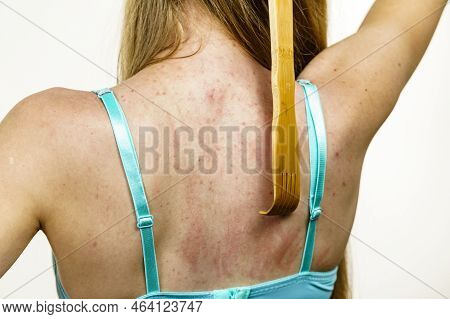 Itchy Skin, Dermatitis, Food Allergies. Woman Using Scratching Wood Stick To Scratch Her Back Side. 