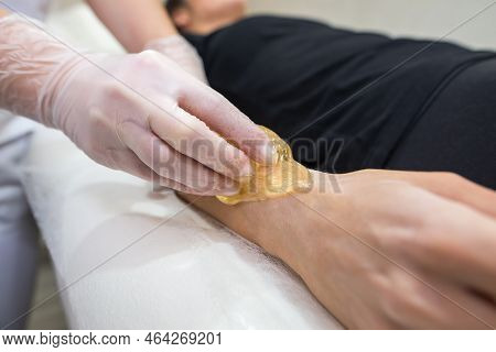Sugar Paste Hair Removal Procedure - Shugaring. Cosmetologist Applies Sugar Paste To The Hand Of A Y
