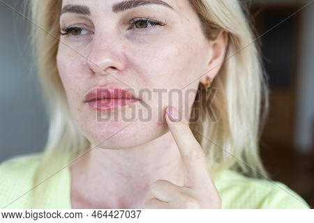 Real Biorevitalization Of The Skin On A White Background. Traces Of Injections Of Biorevitalization 