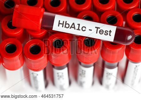 Hba1c Test From Blood , Blood Samples To Be Analyzed In The Laboratory, Red Blood In Test Tube