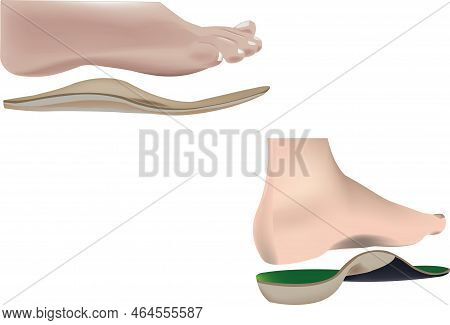 Human Feet With Use Of Insoles Human Feet With Use Of Insoles