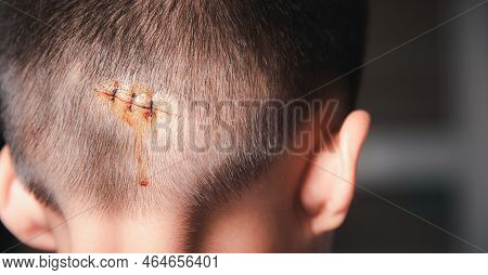 The Lacerated Suture Wound Of Head Which Suture By Nylion Suture About 3 Stitches