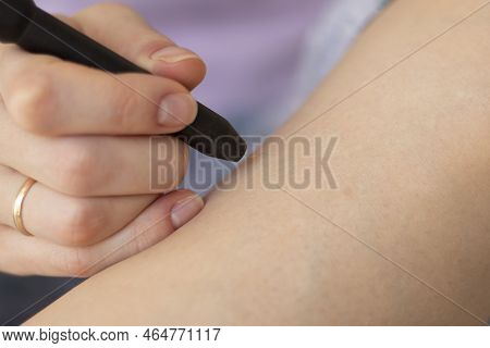 The Process Of Permanent Hair Removal, Removing Unwanted Hair Using An Electroepilation Device, Clos