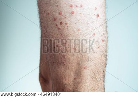 Side View Of Of Bare Legs Of Unrecognizable Man Showing Inflamed Scaly Flaky Skin Suffering From Pso