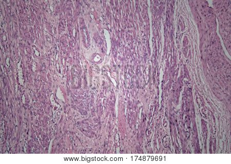 Cells of human uterus tissue with inoffensive tumor cells under a microscope.