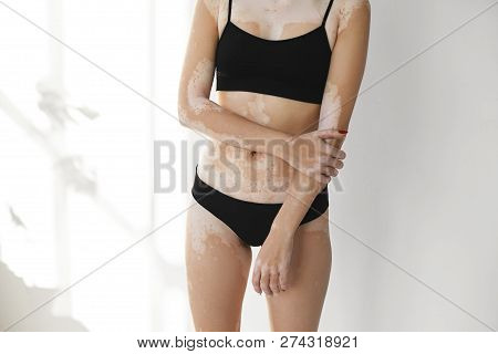 Cropped Shot Of Unrecognizable Female Wearing Black Top And Panties Having Vitiligo Disease, Posing 