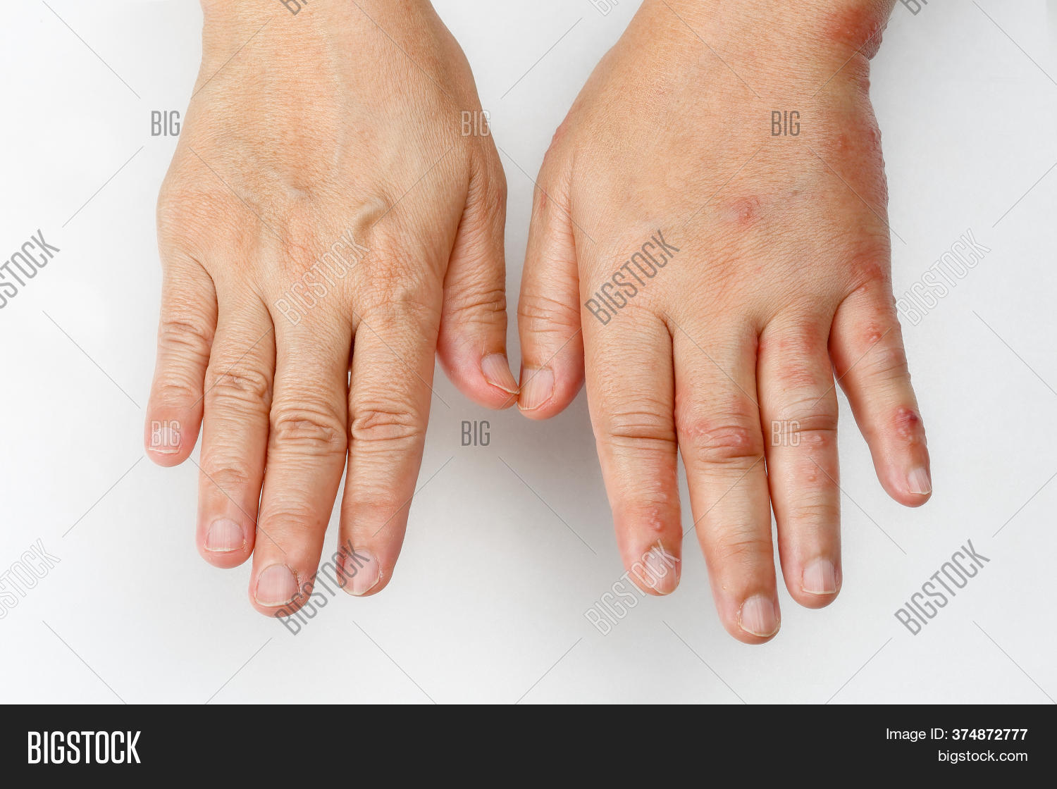 Shingles Disease That Image & Photo (Free Trial) Bigstock