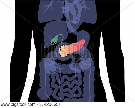 Vector Isolated Illustration Of Ill Pancreas Anatomy. Pancreatitis And Gallstones. Human Digestive S
