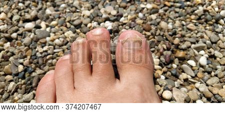 Toes With Fungus - The Concept Of Skin Diseases In The Summer On The Beach